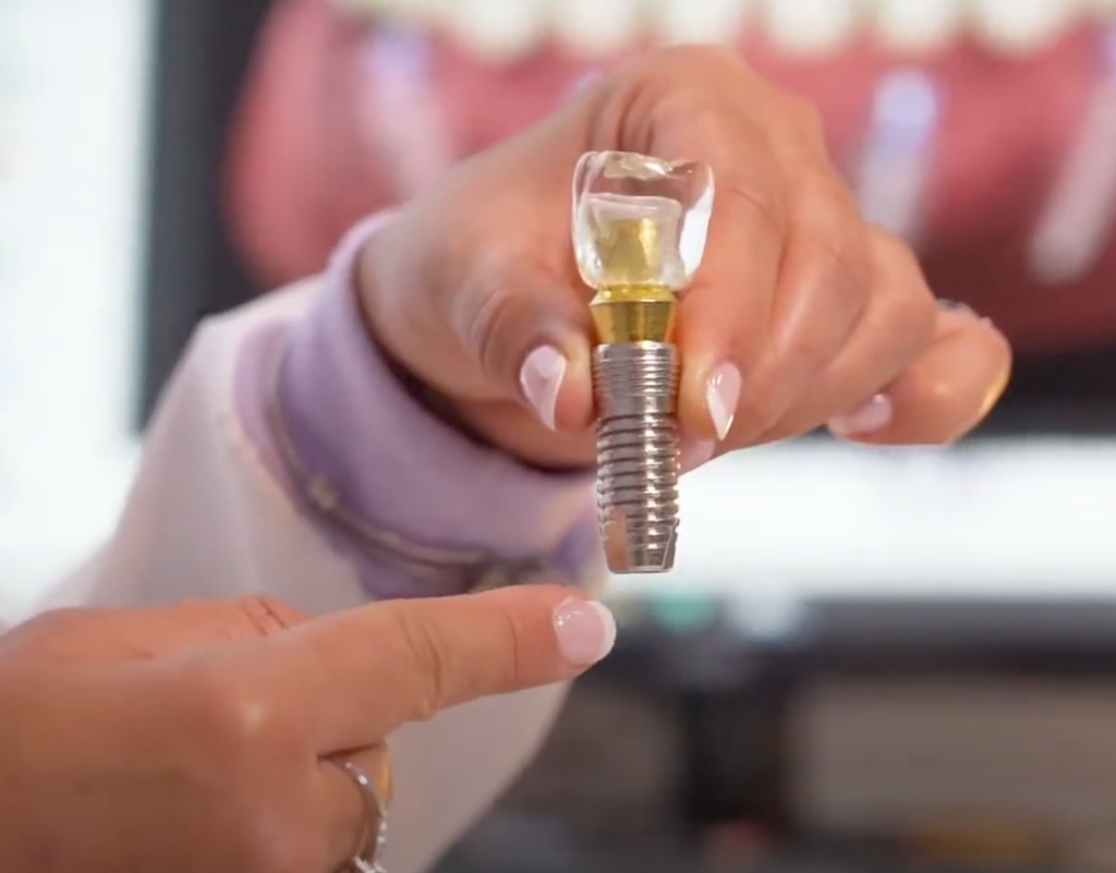 Dental Implant consultation at Sweet Comfort Dentures